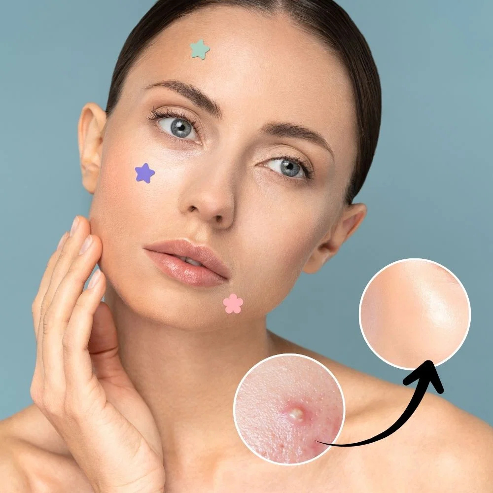 acne-patch-sticker-41191623_2.jpg